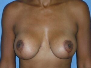 After Image: Breast Augmentation With Mastopexy