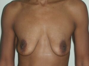 Before Image: Breast Augmentation With Mastopexy