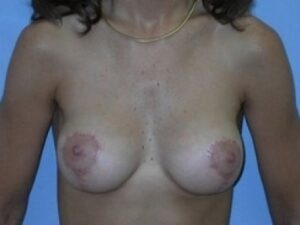 After Image: Breast Augmentation With Mastopexy