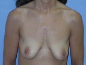 Before Image: Breast Augmentation With Mastopexy