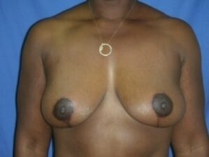 After Image: Breast Augmentation With Mastopexy