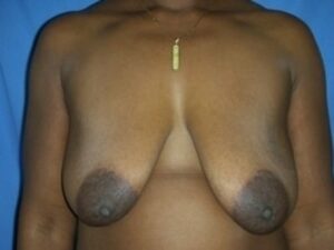 Before Image: Breast Augmentation With Mastopexy