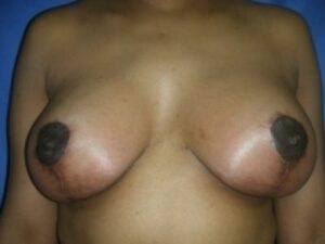 After Image: Breast Augmentation With Mastopexy