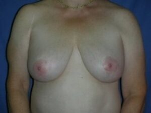 After Image: Breast Augmentation With Mastopexy