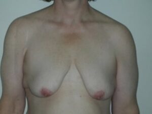 Before Image: Breast Augmentation With Mastopexy