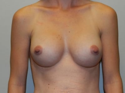 After Image: Breast Augmentation - front