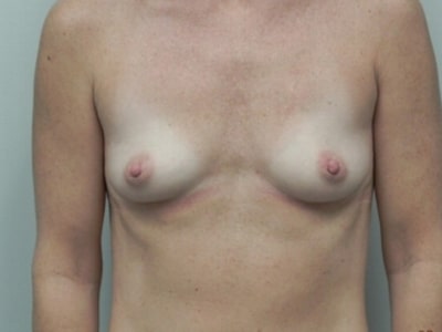 Before Image: Breast Augmentation - front