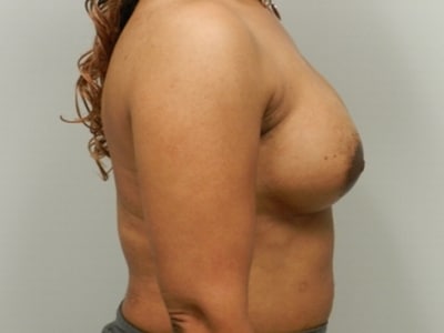 After Image: Breast Augmentation - right-side