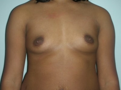 Before Image: Breast Augmentation - front
