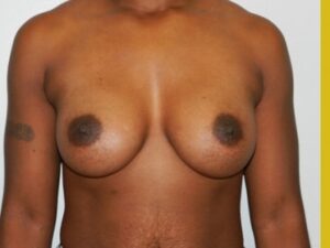 After Image: Breast Augmentation