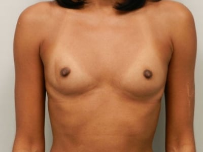 Before Image: Breast Augmentation - front