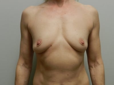 Before Image: Breast Augmentation - front