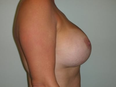 After Image: Breast Augmentation - right-side