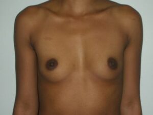 Before Image: Breast Augmentation