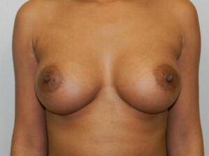 After Image: Breast Augmentation
