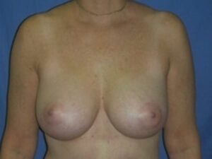 After Image: Breast Augmentation