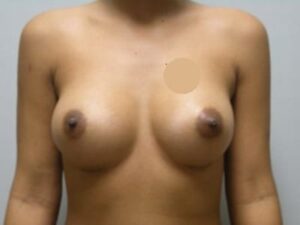 After Image: Breast Augmentation