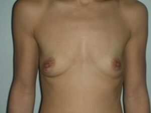 Before Image: Breast Augmentation