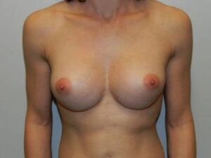 After Image: Breast Augmentation Revision Implant Exchange