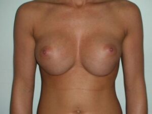 Before Image: Breast Augmentation Revision Implant Exchange