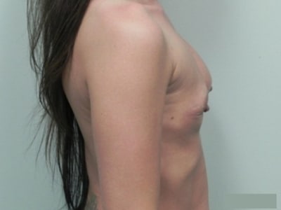 Before Image: Breast Augmentation Revision Implant Exchange - right-side