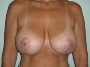 After Image: Breast Augmentation Revision Implant Exchange