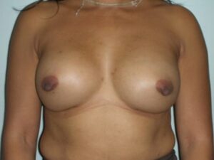 Before Image: Breast Augmentation Revision Implant Exchange