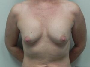 Before Image: Breast Augmentation Revision Implant Exchange