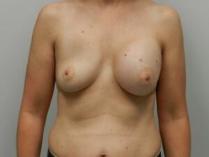 Before Image: Breast Augmentation Revision Implant Exchange