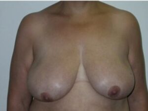 Before Image: Breast Lift