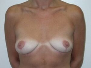 After Image: Breast Lift