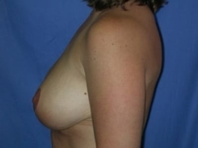 Before Image: Breast Lift - left-side