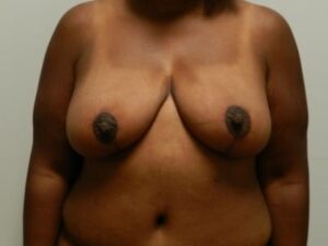 After Image: Breast Lift