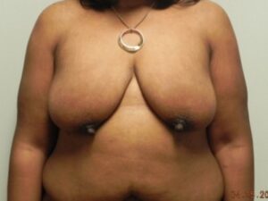 Before Image: Breast Lift