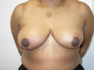 After Image: Breast Reduction