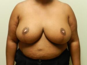After Image: Breast Reduction