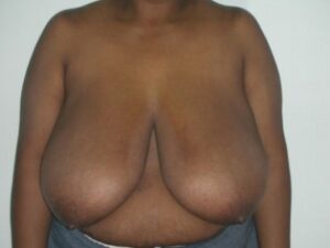 Before Image: Breast Reduction