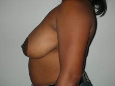 Before Image: Breast Reduction - left-side