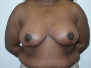 After Image: Breast Reduction