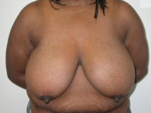 Before Image: Breast Reduction