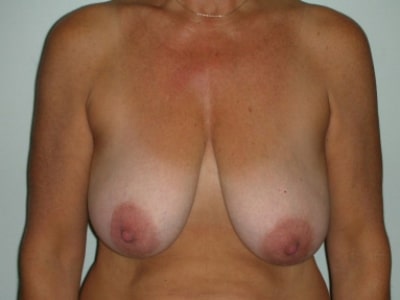 Before Image: Breast Reduction - front