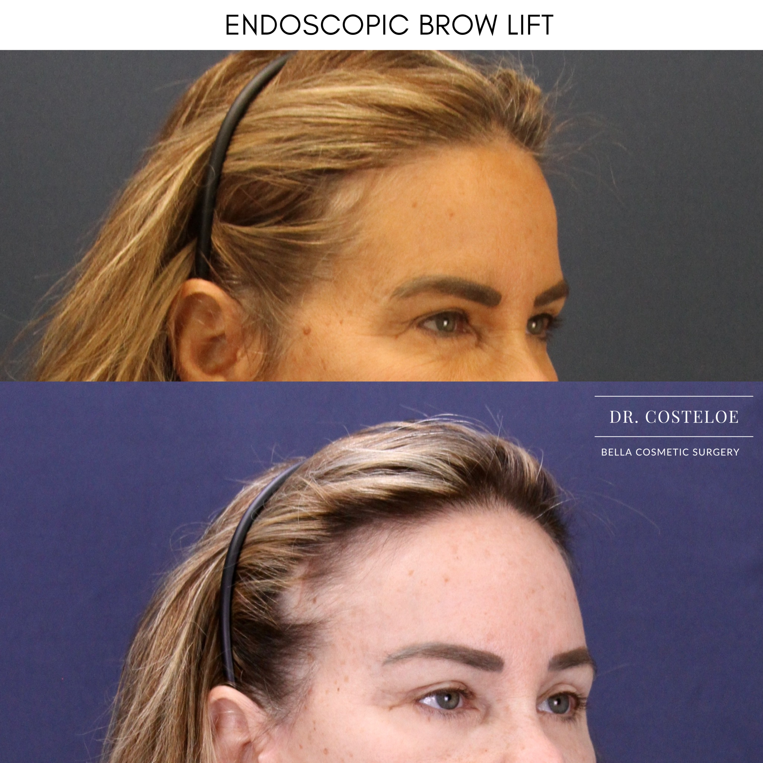 before and after Brow Lift National Harbor MD