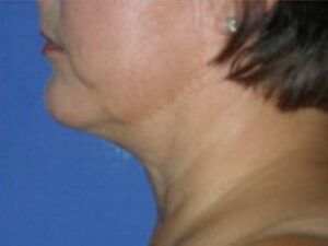After Image: Chin Augmentation