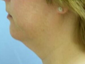 Before Image: Chin Augmentation