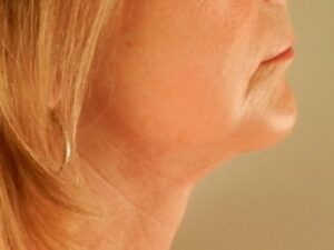 After Image: Chin Implant