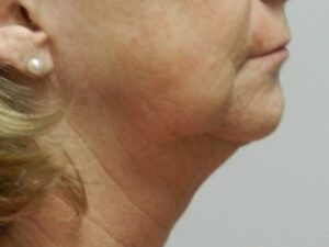 Before Image: Chin Implant