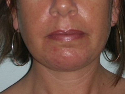 After Image: Chin Augmentation - front