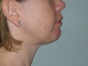 After Image: Chin Augmentation