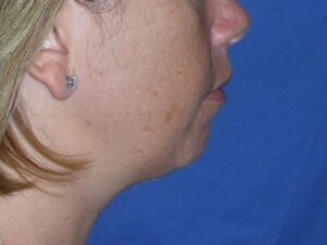 Before Image: Chin Augmentation