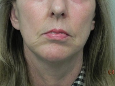 After Image: Chin Augmentation - front